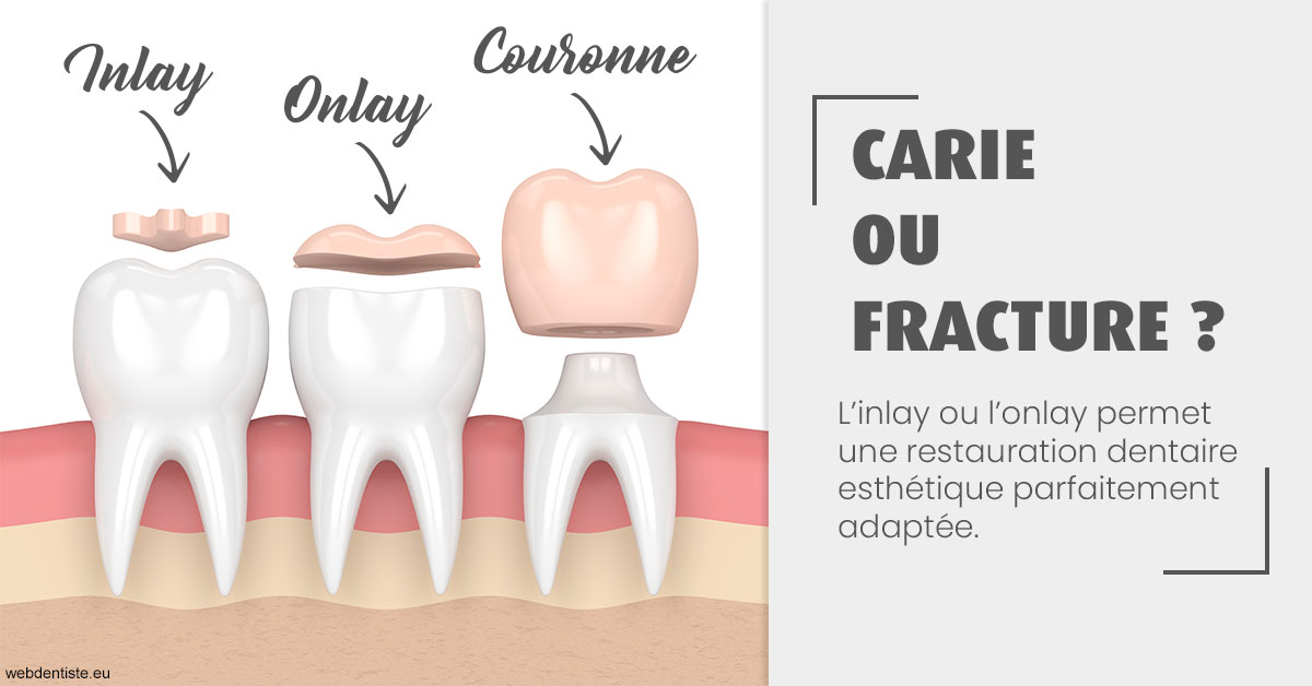 https://dr-pichon-denis.chirurgiens-dentistes.fr/T2 2023 - Carie ou fracture 1