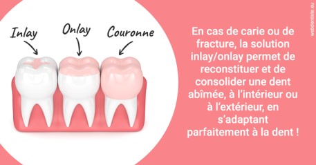 https://dr-pichon-denis.chirurgiens-dentistes.fr/L'INLAY ou l'ONLAY 2
