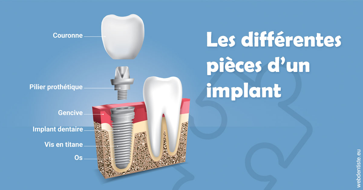 https://dr-pichon-denis.chirurgiens-dentistes.fr/Les différentes pièces d’un implant 1